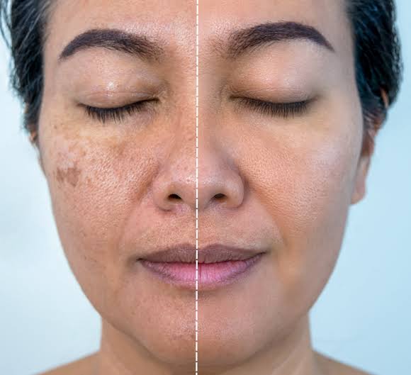 De-pigmentation Treatment Image